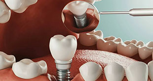 dental implant clinic gurgaon